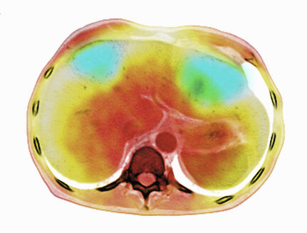 Bild aus einer ko-registrierten PET-CT-Studie mit einem Dual-Modality-Scanner. Patient mit multiplen metastatischen Läsionen in Leber und Lunge. PET-Daten überlagert mit einem axialen CT-Scan-Schichtbild durch die Lebermetastasen - CUF28260