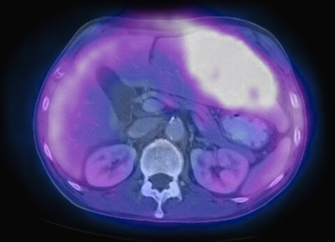 Bild aus einer ko-registrierten PET-CT-Studie mit einem Dual-Modality-Scanner. Patient mit multiplen metastatischen Läsionen in Leber und Lunge. PET-Daten überlagert mit einem axialen CT-Scan-Schichtbild durch die Lebermetastasen, lizenzfreies Stockfoto