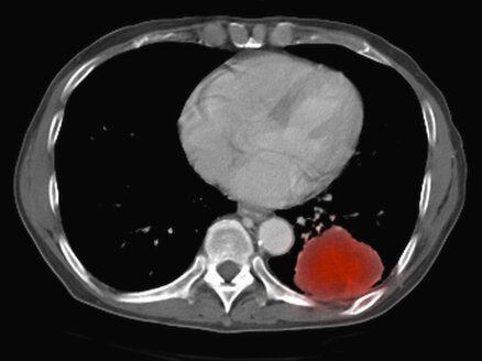 Bild aus einer ko-registrierten PET-CT-Studie mit einem Dual-Modality-Scanner. Patient mit multiplen metastatischen Läsionen in Leber und Lunge. PET-Daten überlagert mit einer axialen Schicht des CT-Scans durch die Lungenmetastasen - CUF28262