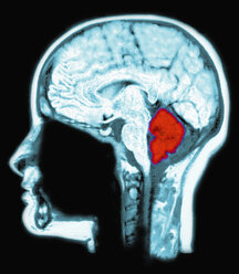 MRT-Aufnahme des Gehirns, computeroptimiert zur Hervorhebung des Kleinhirns (rot) - CUF29009