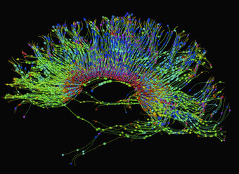 Diffusions-MRT, auch Diffusions-Tensor-Imaging oder DTI genannt, des menschlichen Gehirns - CUF29010