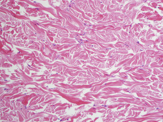 H&E-Färbung, Lichtmikroskopie, reichlich Kollagen in einem Gardner-Fibrom - CUF32545