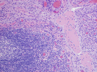 H&E-Färbung, Lichtmikroskopie, rheumatoide Arthritis des Gelenks mit Pannus - CUF32552