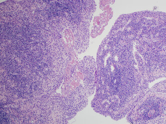 H&E-Färbung, Lichtmikroskopie, rheumatoide Arthritis des Gelenks mit Entzündung und Hyperplasie - CUF32553