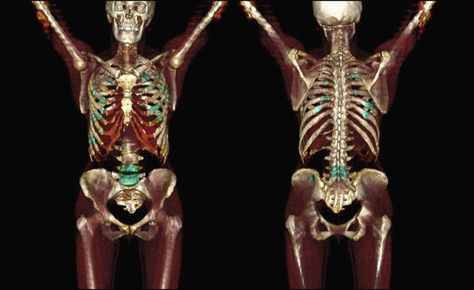 3D-CT-Scan von metastasierendem Knochenkrebs - CUF39530