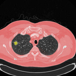 Thorax-CT (Röntgen-Computertomographie) eines 54-jährigen Patienten, bei dem ein Tumor im linken Oberlappen der Lunge zu erkennen ist - CUF41696