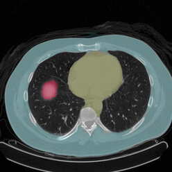 Positronen-Emissions-Tomographie (PET) eines 54-jährigen männlichen Patienten, bei dem ein Tumor im linken Oberlappen der Lunge zu erkennen ist - CUF41697