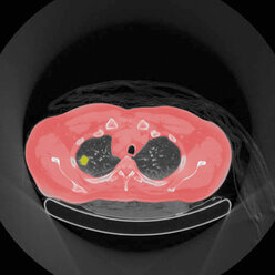 Positronen-Emissions-Tomographie (PET) eines 54-jährigen männlichen Patienten, bei dem ein Tumor im linken Oberlappen der Lunge zu erkennen ist - CUF41698