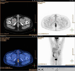 Zusammengesetzte Positronen-Emissions-Tomographie (PET)-Aufnahmen eines 54-jährigen Patienten, bei dem ein Tumor im linken Oberlappen der Lunge zu erkennen ist - CUF41699