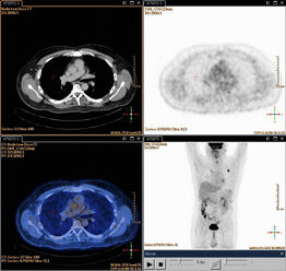 Zusammengesetzte Positronen-Emissions-Tomographie (PET)-Aufnahmen des Brustkorbs eines männlichen Patienten im Alter von 54 Jahren, bei dem ein Tumor im linken Oberlappen der Lunge zu erkennen ist - CUF41700