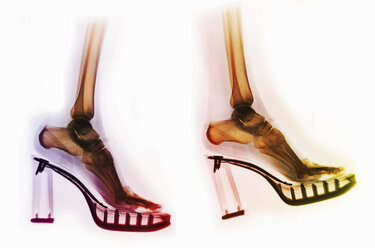 X-ray of feet in a pair of high heel shoes - CUF43022