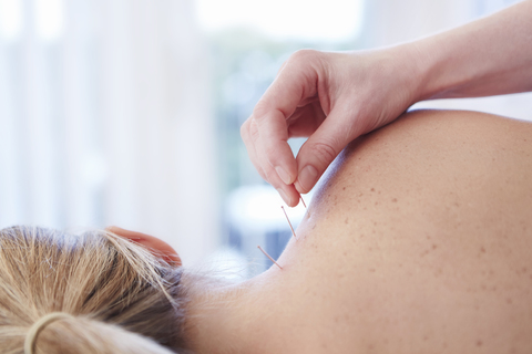 Frau erhält Akupunktur in der Schulter, lizenzfreies Stockfoto