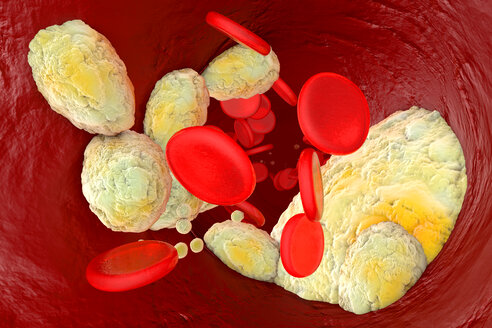 3D gerenderte Illustration, Visualisierung von Fett, das eine Arterie verstopft und die Krankheit Arteriosklerose verursacht - SPCF00355