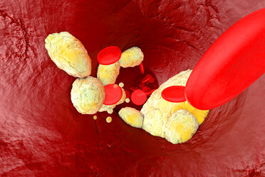 3D gerenderte Illustration, Visualisierung von Fett, das eine Arterie verstopft und die Krankheit Arteriosklerose verursacht - SPCF00392