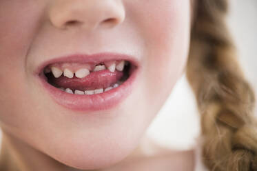Kaukasisches Mädchen wackelt mit losem Zahn - BLEF10174