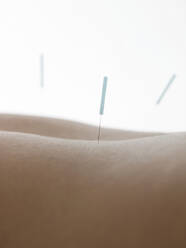 Nahaufnahme von Akupunkturnadeln im Rücken einer Frau - BLEF12164