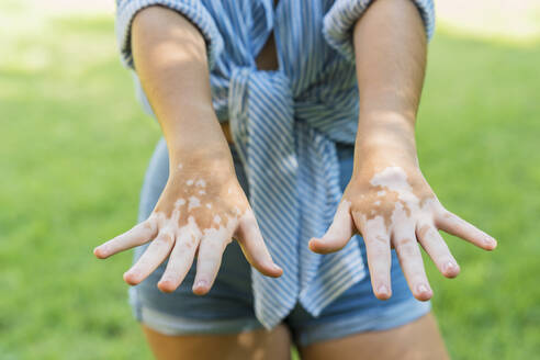 Detail der Hände eines Mädchens mit Hautdepigmentierung oder Vitiligo - DLTSF00214