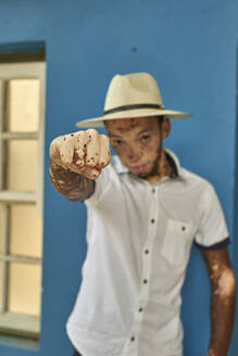 Portrait of young man with vitiligo wearing a hat - VEGF01334