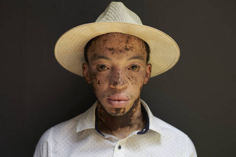 Portrait of young man with vitiligo wearing a hat stock photo