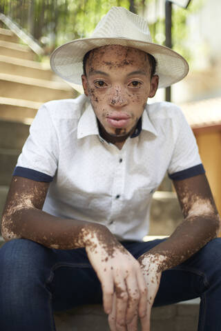 Portrait of young man with vitiligo wearing a hat and sitting on the stairs stock photo