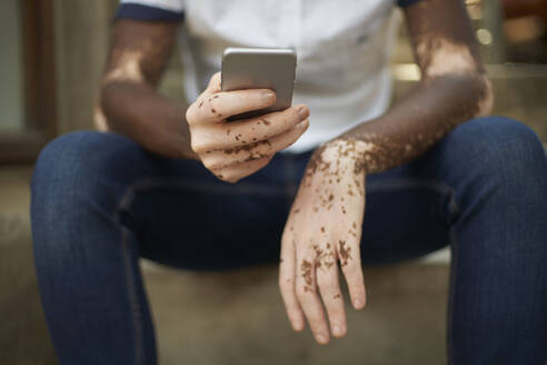 Young man with vitiligo using smartphone - VEGF01354