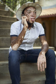 Young man with vitiligo using smartphone - VEGF01355