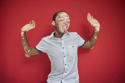 Young man with vitiligo dancing in front of a red wall - VEGF01359