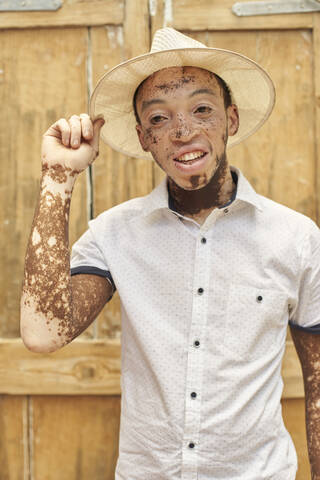 Portrait of young man with vitiligo wearing a hat stock photo