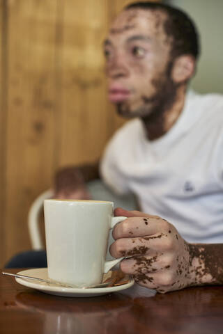 Junger Mann mit Vitiligo sitzt in einer Cafeteria und hält einen Kaffeebecher, lizenzfreies Stockfoto