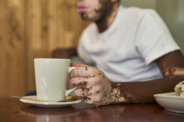 Nahaufnahme der Hand eines Mannes mit Vitiligo, der einen Kaffeebecher hält - VEGF01371