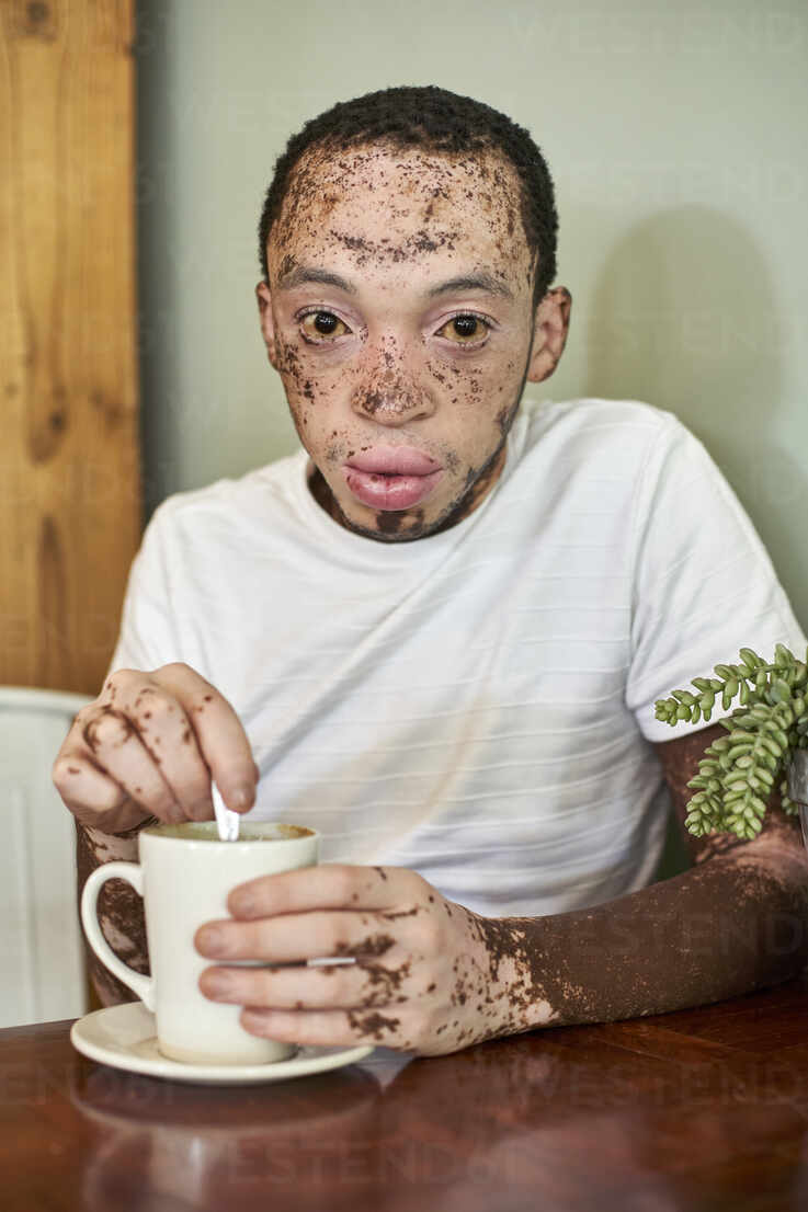 Young man with vitiligo having a cup of coffee in a cafeteria stock photo