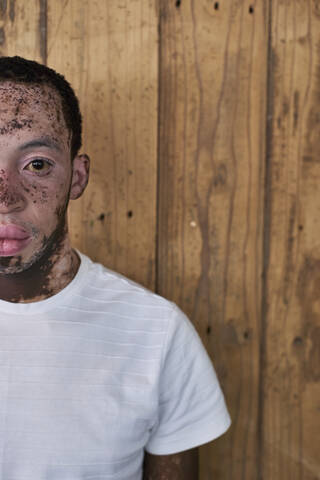 Half portrait of a young man with vitiligo in front of a wooden wall stock photo