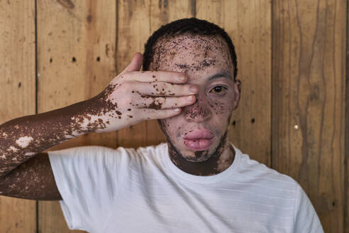 Porträt eines Mannes mit Vitiligo, der sein Auge mit einer Hand bedeckt - VEGF01379