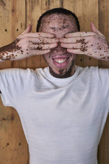 Porträt eines Mannes mit Vitiligo, der sein Auge mit einer Hand bedeckt - VEGF01380