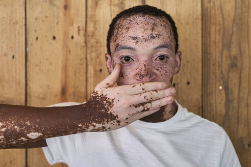 Junger Mann mit Vitiligo, der seinen Mund mit der Hand bedeckt - VEGF01381