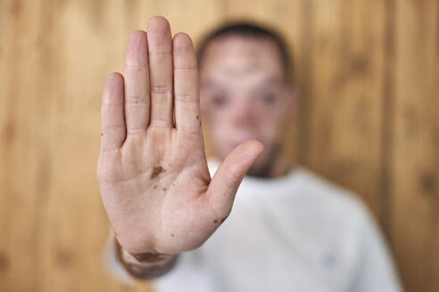 Nahaufnahme der Hand eines Mannes mit Vitiligo - VEGF01382