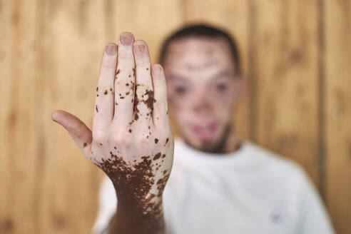 Junger Mann mit Vitiligo - VEGF01383