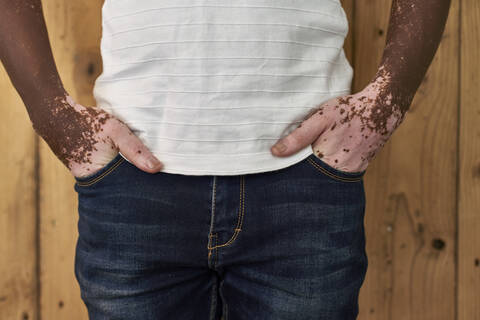 Nahaufnahme des Körpers eines Mannes mit Vitiligo an einer Holzwand, lizenzfreies Stockfoto