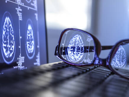 Brain scan results reflecting in protective glasses lying on laptop keyboard - ABRF00706