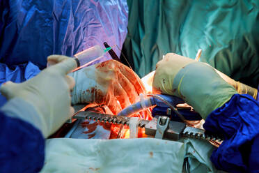 Ausgeschnittenes Bild von Chirurgen, die eine Operation durchführen - EYF01983