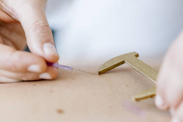Akupunktur, Hand mit Schieblehre auf dem Rücken mit Akupunkturnadel während der Behandlung - DAWF01671