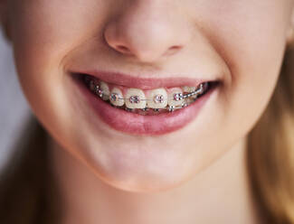 Close-Up Of Smiling Girl Wearing Braces - EYF08229