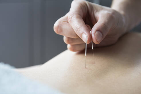Close up acupuncturist applying acupuncture needles to woman’s back - ABZF03260