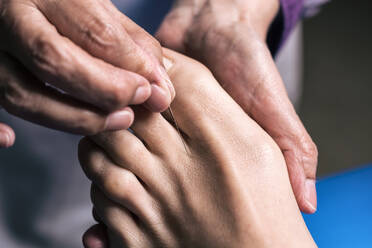 Therapist performing an acupuncture treatment on a patient woman - ADSF04730