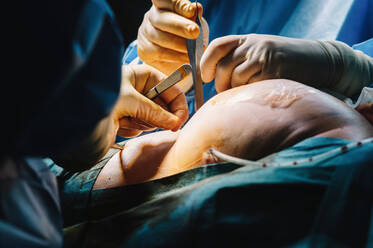 Plastischer Chirurg näht die Brust einer Patientin nach dem Einsetzen von Implantaten im Operationssaal zu - ADSF07975