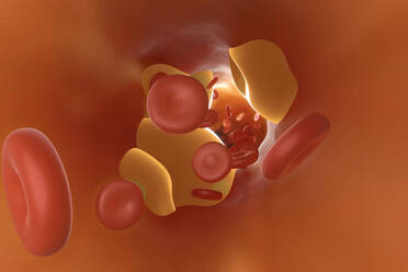 Dreidimensionale Darstellung einer durch Cholesterin verstopften Arterie - SPCF00887