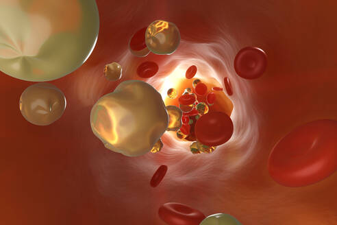 Dreidimensionale Darstellung einer durch Cholesterin verstopften Arterie - SPCF00888