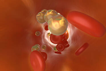 Three dimensional render of cholesterol clogging vein - SPCF00930