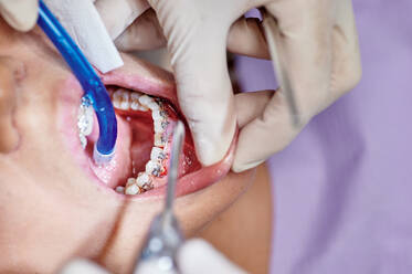 Oben: ein gesichtsloser Patient mit Zahnspange bei der Reinigung in einer modernen Zahnklinik - ADSF15041