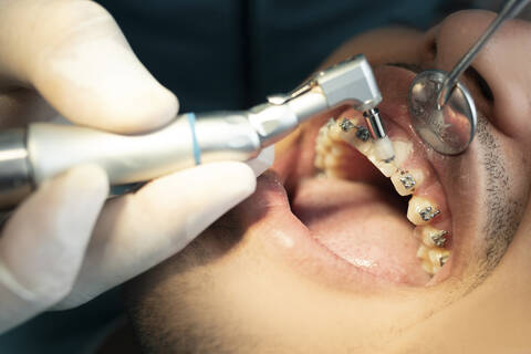 Hand of orthodontist using dental drill on male patient wearing braces stock photo